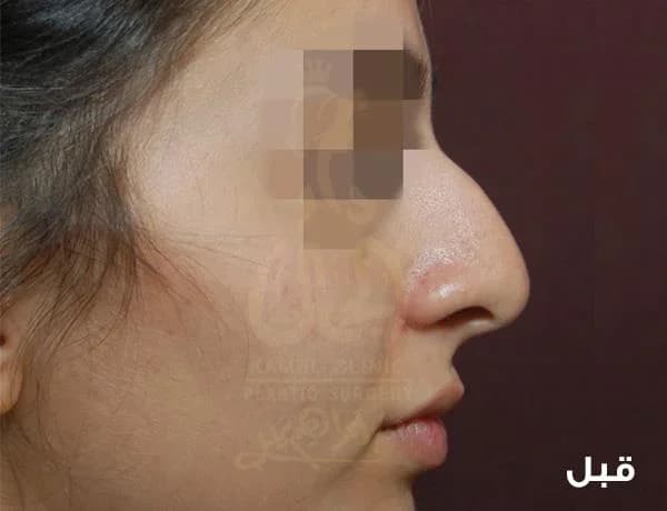 قبل — تجميل الأنف