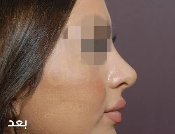 بعد — تجميل الأنف