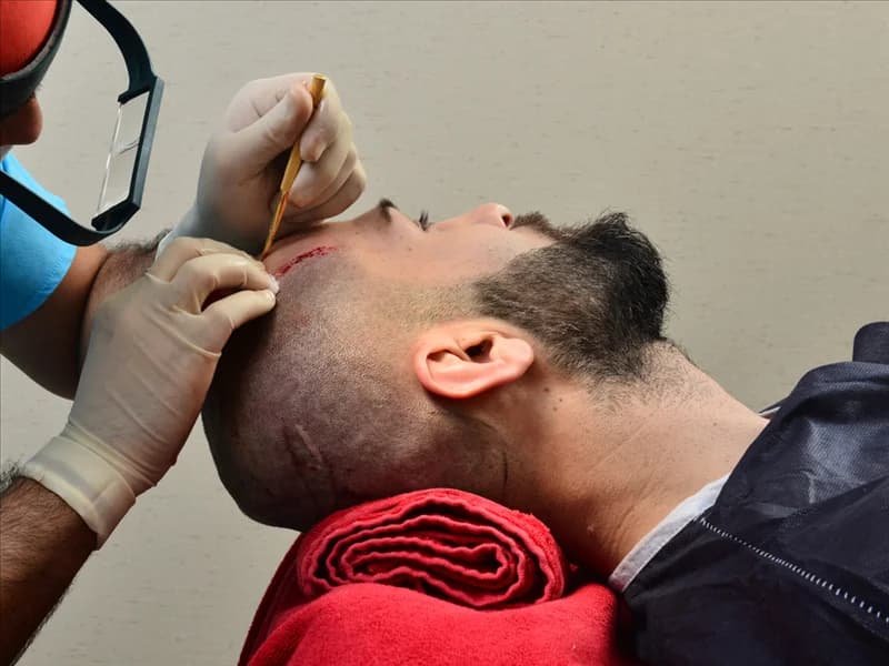 زراعة الشعر
