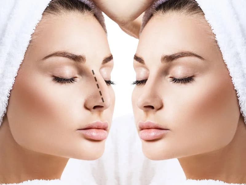 تجميل الأنف