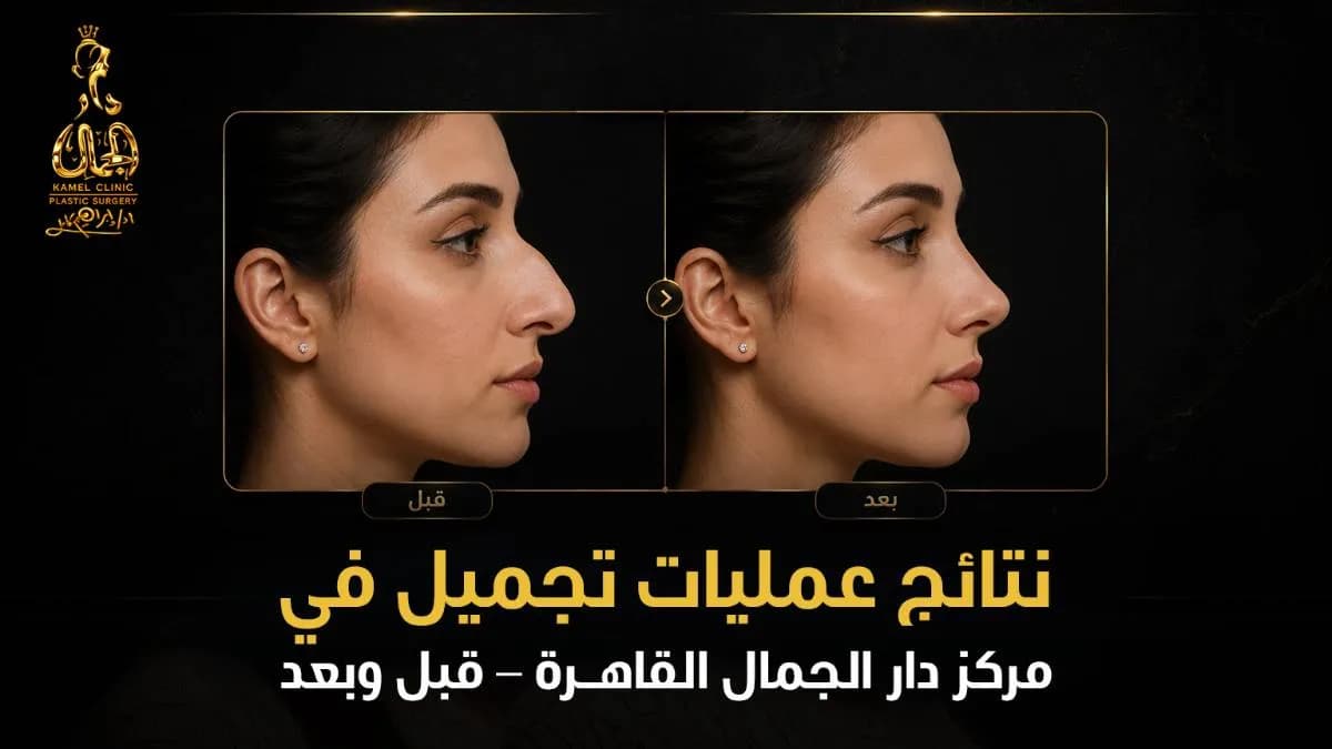صور قبل وبعد حقيقية لعمليات تجميل بموافقة العملاء (أنف، شفط دهون)